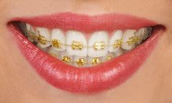 Orthodontics in Milton ON